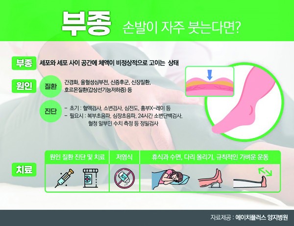 자주 붓는 손발… 신장•심장질환  의심해보셨나요?